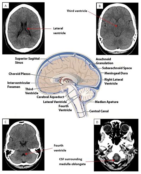 Ventricles Of The Brain Ct - sharedoc