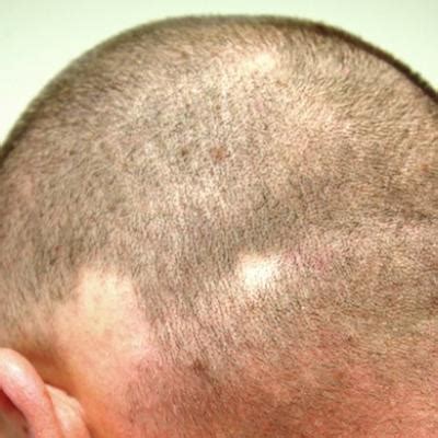 Hair Loss Comes And Goes Always Causing Distress Clinician Reviews