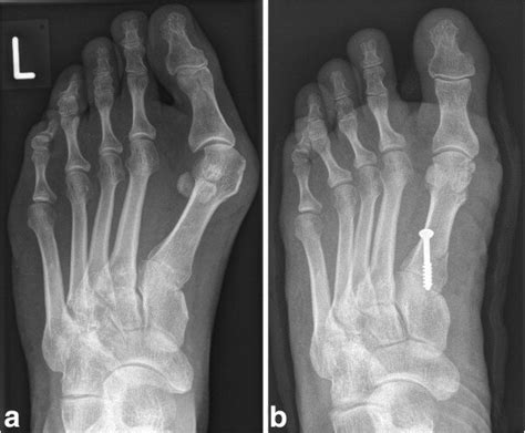 Pre And Postoperative Radiographs Weightbearing Ap Radiographs Of The