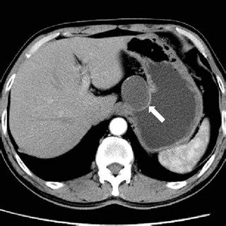 CT scan of the abdomen. CT scan of the abdomen demonstrated a... | Download Scientific Diagram