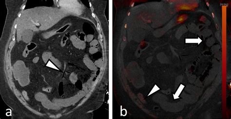 Abdominal Portal Venous Phase Dual Energy CT Dual Source 58 Year Old