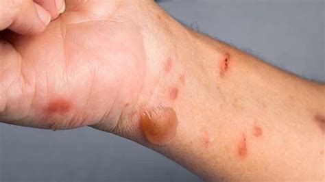 Burns Types Symptoms And Treatments