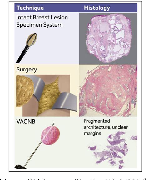 Figure 1 From Evaluation Of Percutaneous Vacuum Assisted Intact