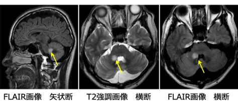 多発性硬化症とは｜八重洲クリニック 脳神経外科