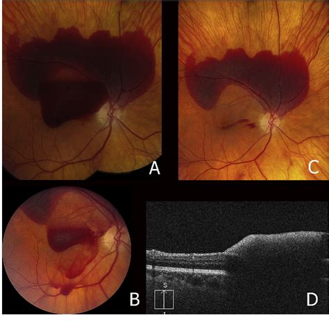 Figure 3 From Ndyag Membranotomy For Preretinal Hemorrhage Secondary