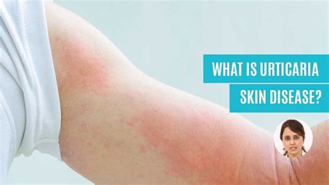 What Is Urticaria Hives Skin Disease Causes Symptoms Diagnosis