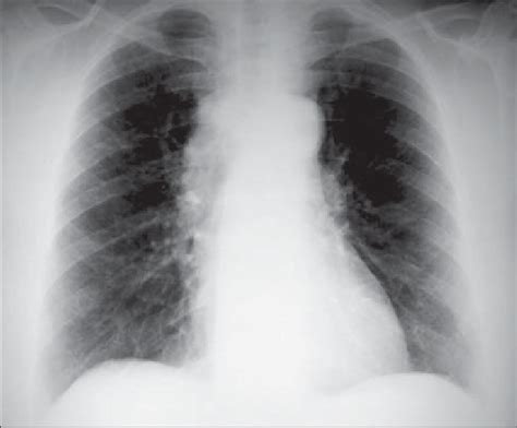 Radiografia de tórax em póstero anterior demonstrando alargamento