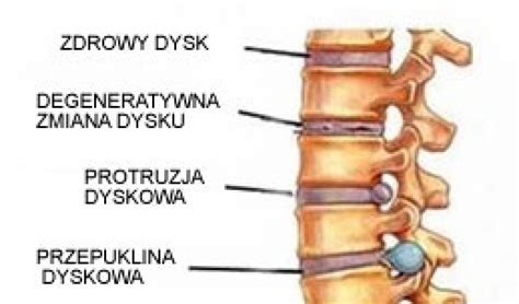 Przepukliny Kr Gos Upa Objawy Leczenie Kr Gos Upa Krak W D Bica