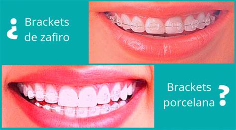 Brackets De Zafiro O Brackets De Porcelana Blog Masquemedicos