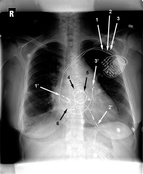 Aortic Valve Location In Chest At Eric Webb Blog