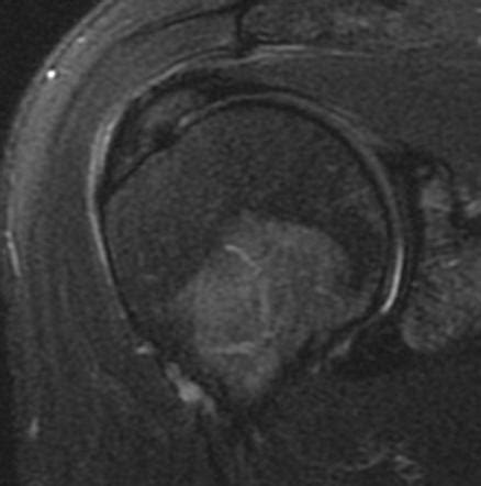 Supraspinatus tendinosis | Radiology Case | Radiopaedia.org