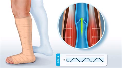 Understanding Compression Therapy For Venous And Mixed Leg Ulcers Urgo Medical Healthcare