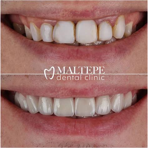 Everything About Composite Veneers Maltepe Dental Clinic