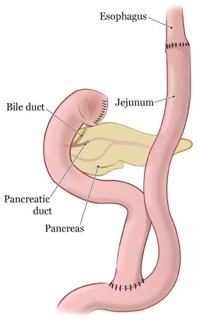 Gastrectomy Procedure Cape Town Hepato Pancreato Biliary Surgery