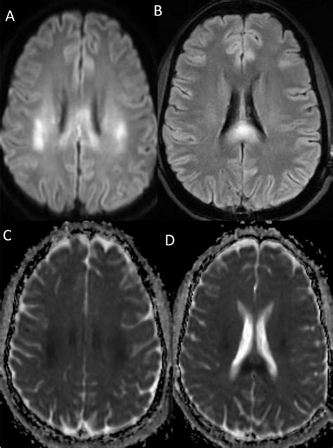 Figure From Severe Hyponatremia And Bilateral Sequential Facial Palsy