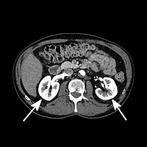 Ct Scan Kidney Stock Photos Pictures And Royalty Free Images Istock