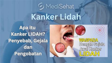 Kanker Lidah Penyebab Gejala Dan Cara Mengobati Berobatkepenang