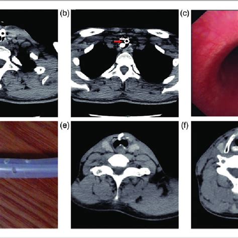 Follow Up A B Computed Tomography Examination 1 Month After Surgery