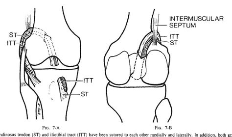 Figure 7 From Combined Anterior Cruciate Ligament Reconstruction Using