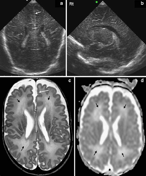 Coronal A And Parasagittal B Cus Scan Of A Preterm Infant Ga