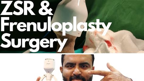 Frenuloplasty And Zsr Circumcision For Phimosis Frenulum Breve By Dr