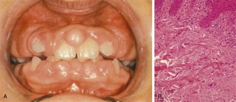 Lesions Of The Oral Cavity Clinical Tree