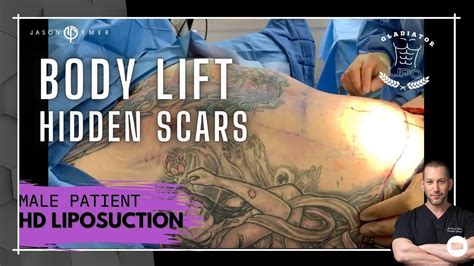 Body Lift With HIDDEN SCARS Male Gladiator 360 HD Lipo Tummy Tuck