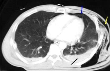 Rib Fracture Imaging And Diagnosis Practice Essentials Radiography