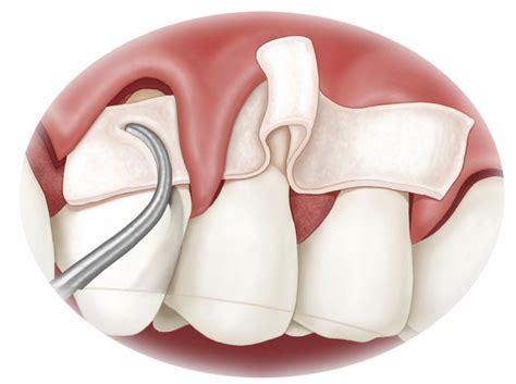 La Chirurgie Plastique Parodontale I Dentiste Divonne