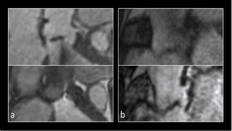 Self Navigated Versus Navigator Gated 3d Mri Sequence For Non Enhanced Aortic Root Measurement