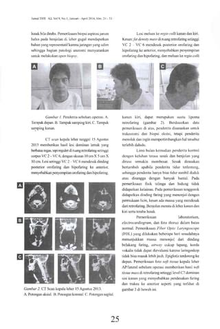 Eksisi Fibrolipoma Retrofaring Dengan Pendekatan Transcervical Laporan