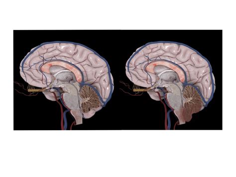 Chiari Malformasyonu Beyincik Sarkmas Tedavisi Prof Dr Kenan Ko