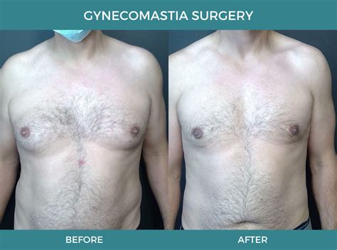 Male Breast Reduction Surgery Va Berman Cosmetic Surgery