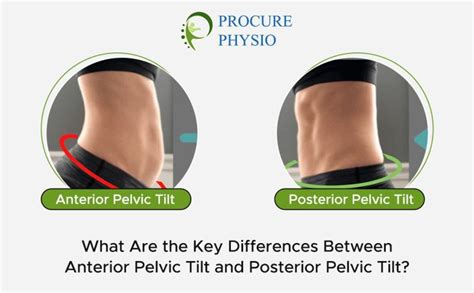 What Are the Key Differences Between Anterior Pelvic Tilt and Posterior Pelvic Tilt?