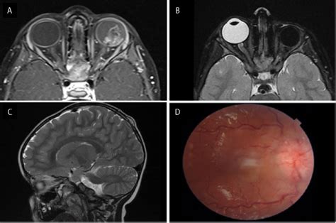 Metastatic Unilateral Retinoblastoma To The Contralateral Orbital Optic