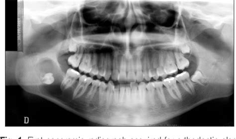 Figure 1 From Aggressive Unicystic Ameloblastoma Affecting The