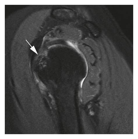 A 64 Year Old Woman With Left Shoulder Pain After A Fall Axial A And