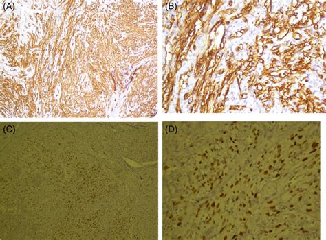 Immunohistochemistry Examination Of Tissue Sample For Cd34 A And B