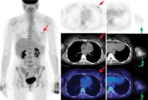 Ajr Teaching File Incidental Breast Cancer Detected With F Fdg Pet