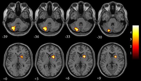 Frontiers Aberrant Brain Regional Homogeneity And Functional