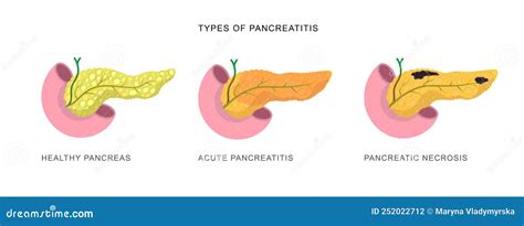 Infographics Demonstrating The Difference Of Pancreatitis And