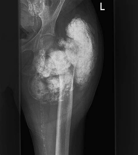 Invasive Uraemic Calcinosis Of The Hip Clinical Radiology