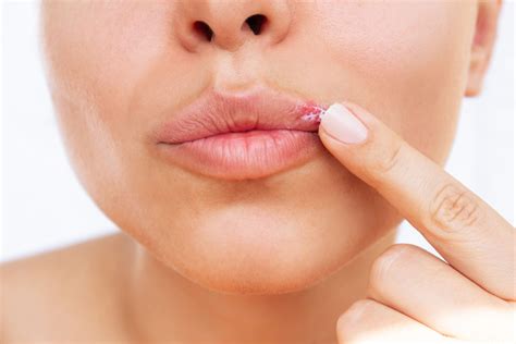 Herpes Labial Tratamiento Y S Ntomas Cl Nica Dental De Terrassa