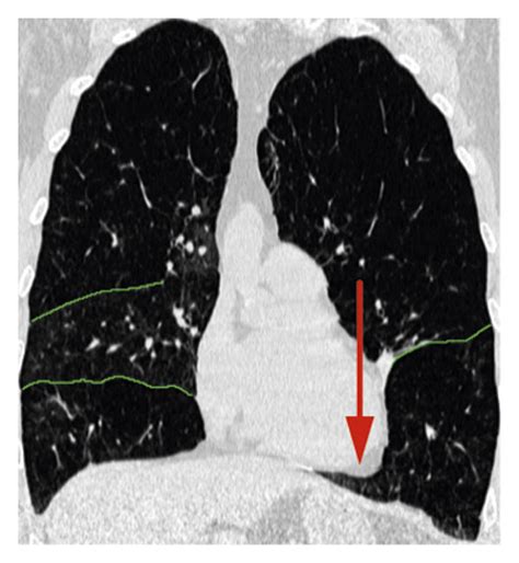 The Segmented Lung Lobes Are Marked With Different Colors The Upper Download Scientific