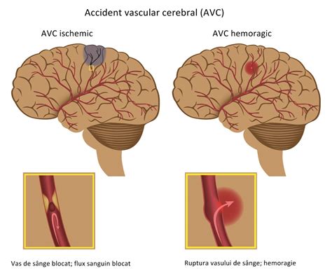 Factori de risc pentru AVC specifici femeilor identificați