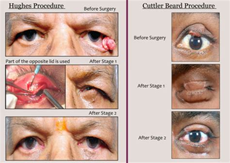 Cancers Around The Eye Dr Kruti