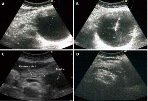 Appearance on ultrasound of a pancreatic pseudocyst before, during and... | Download Scientific ...