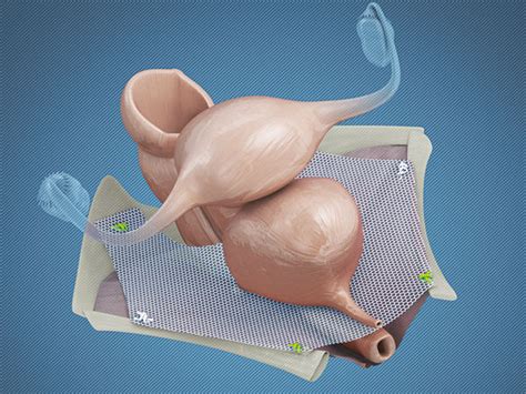 Pelvic Floor Reconstruction Reconstruction Mesh Ingynious Ami