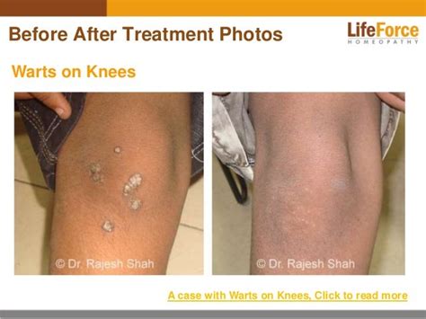 Warts Before and After Treatment Photos: Find Pictures of Cases Treat…