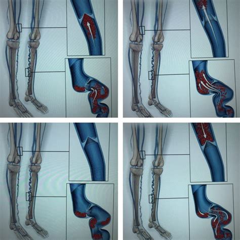 Venous Reflux Worksheet